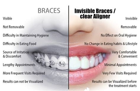 Clear Braces: Types, Cost, Alternatives & More .